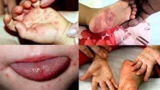 KHUYẾN CÁO PHÒNG CHỐNG BỆNH TAY CHÂN MIỆNG
