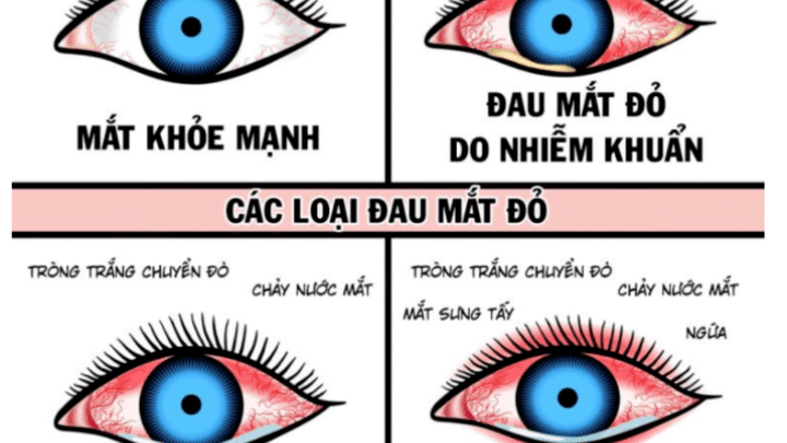 CDC Quảng Ninh khuyến cáo phòng bệnh đau mắt đỏ