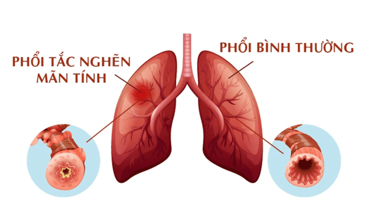 Bệnh phổi tắc nghẽn mạn tính: Nguyên nhân gây tử vong xếp hàng thứ 3