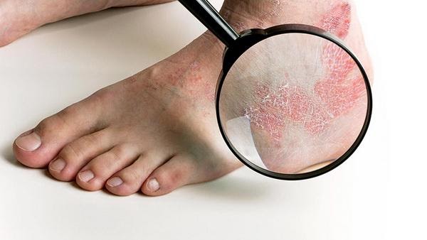 Khi có biểu hiện nghi ngờ nhiễm nấm da bàn chân, cần tới các phòng khám da liễu để khám và điều trị.